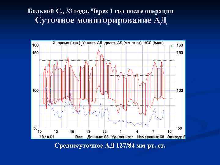 Больной С. , 33 года. Через 1 год после операции Суточное мониторирование АД Среднесуточное