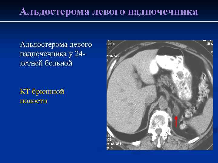 Альдостерома левого надпочечника у 24 летней больной КТ брюшной полости 