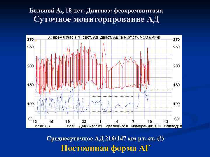 Больной А. , 18 лет. Диагноз: феохромоцитома Суточное мониторирование АД Среднесуточное АД 216/147 мм