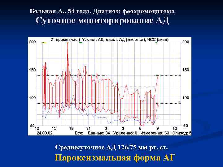 Больная А. , 54 года. Диагноз: феохромоцитома Суточное мониторирование АД Среднесуточное АД 126/75 мм
