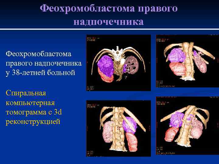 Рак легкого факультетская терапия презентация