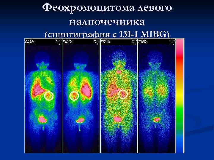 Феохромоцитома левого надпочечника (сцинтиграфия с 131 -I MIBG) 