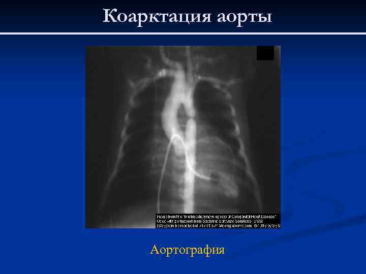 Коарктация аорты Аортография 