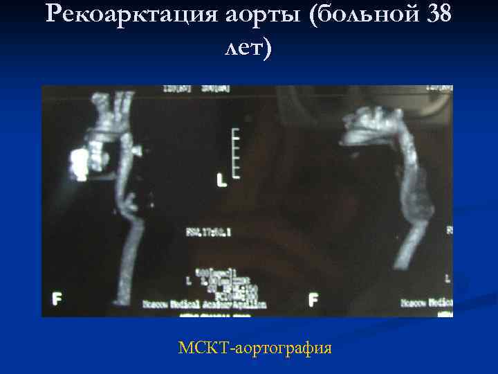 Рекоарктация аорты (больной 38 лет) МСКТ-аортография 