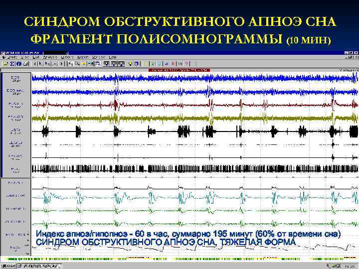 СИНДРОМ ОБСТРУКТИВНОГО АПНОЭ СНА ФРАГМЕНТ ПОЛИСОМНОГРАММЫ (10 МИН) Индекс апноэ/гипопноэ - 60 в час,