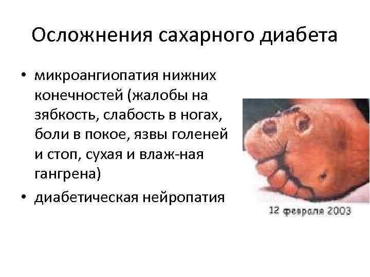 Осложнения сахарного диабета • микроангиопатия нижних конечностей (жалобы на зябкость, слабость в ногах, боли