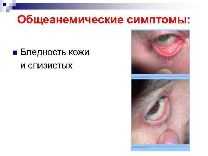 Общеанемические симптомы: n Бледность кожи и слизистых 