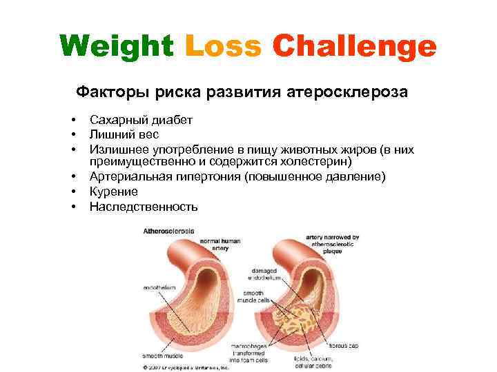 Weight Loss Challenge Факторы риска развития атеросклероза • • • Сахарный диабет Лишний вес