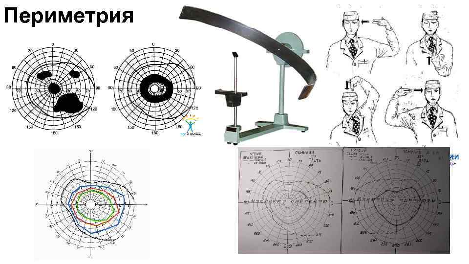 Компьютерная периметрия