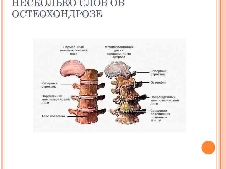 НЕСКОЛЬКО СЛОВ ОБ ОСТЕОХОНДРОЗЕ 