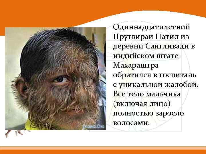 Одиннадцатилетний Прутвирай Патил из деревни Сангливади в индийском штате Махараштра обратился в госпиталь с