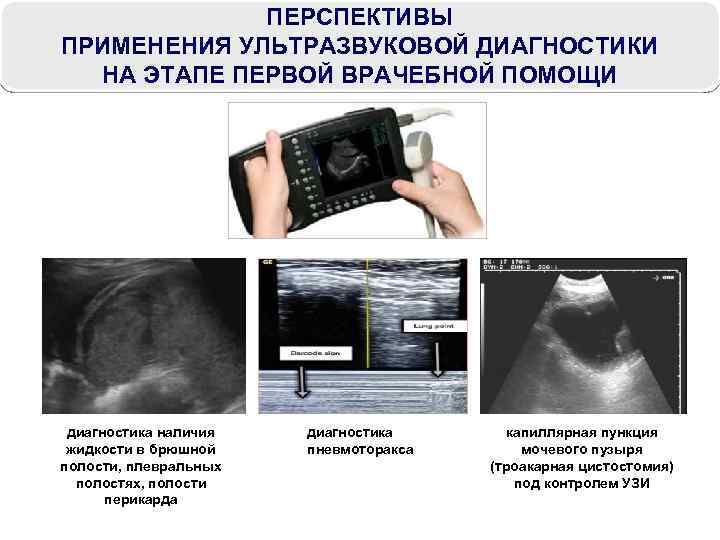 ПЕРСПЕКТИВЫ ПРИМЕНЕНИЯ УЛЬТРАЗВУКОВОЙ ДИАГНОСТИКИ НА ЭТАПЕ ПЕРВОЙ ВРАЧЕБНОЙ ПОМОЩИ диагностика наличия жидкости в брюшной