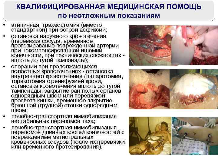 КВАЛИФИЦИРОВАННАЯ МЕДИЦИНСКАЯ ПОМОЩЬ по неотложным показаниям • атипичная трахеостомия (вместо стандартной) при острой асфиксии;