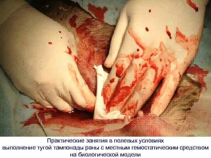Практические занятия в полевых условиях выполнение тугой тампонады раны с местным гемостатическим средством на