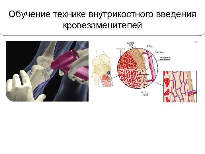 Обучение технике внутрикостного введения кровезаменителей 