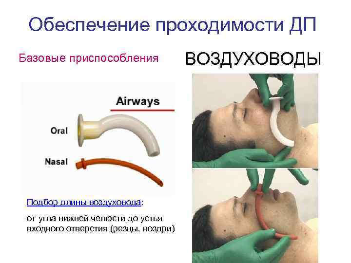 Обеспечение проходимости ДП Базовые приспособления Подбор длины воздуховода: от угла нижней челюсти до устья