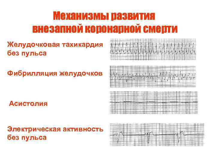 Механизмы развития внезапной коронарной смерти Желудочковая тахикардия без пульса Фибрилляция желудочков Асистолия Электрическая активность