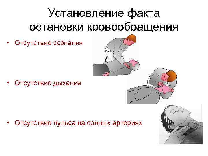 Установление факта остановки кровообращения • Отсутствие сознания • Отсутствие дыхания • Отсутствие пульса на