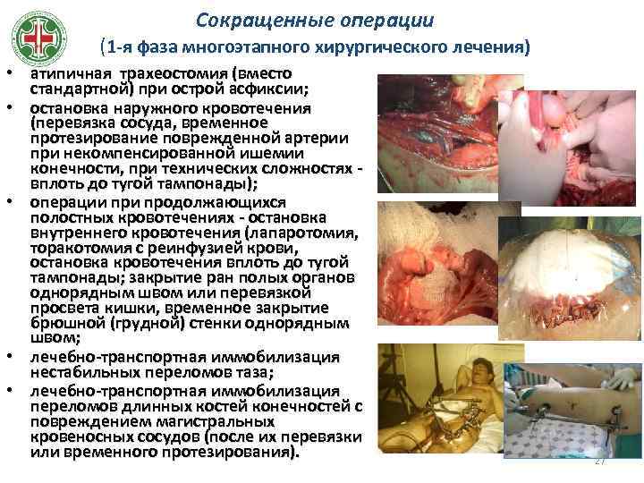 Сокращенные операции (1 -я фаза многоэтапного хирургического лечения) • атипичная трахеостомия (вместо стандартной) при