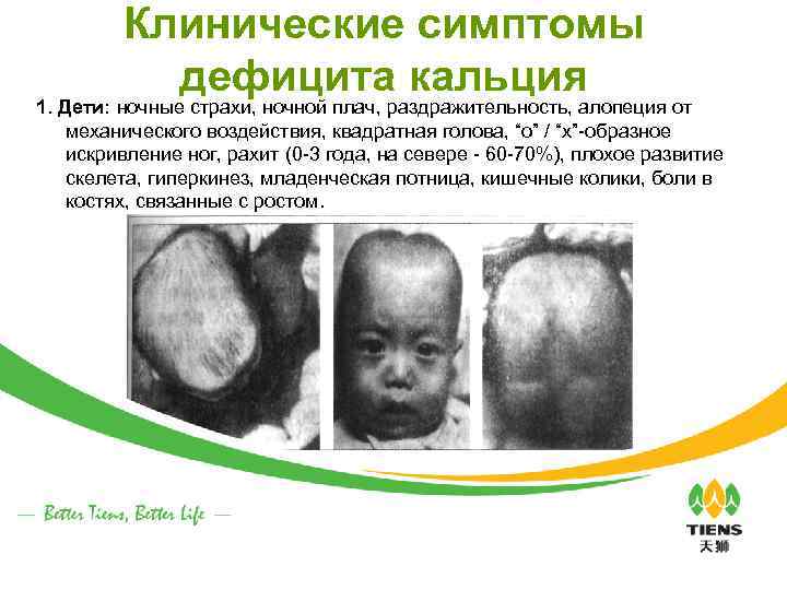 Клинические симптомы дефицита кальция 1. Дети: ночные страхи, ночной плач, раздражительность, алопеция от механического