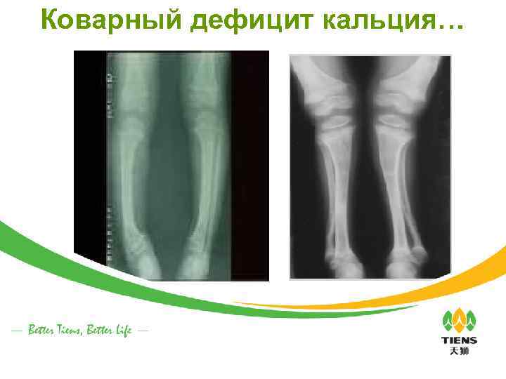 Коварный дефицит кальция… 