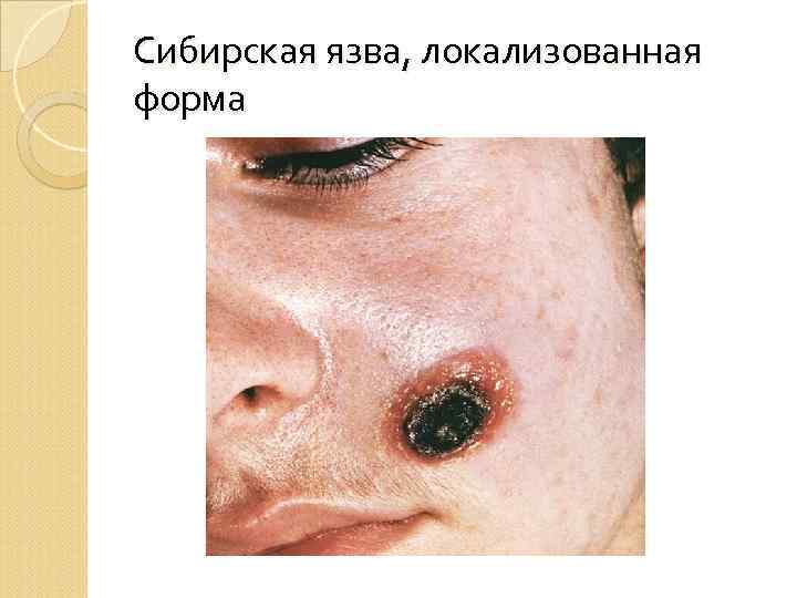 Сибирская язва, локализованная форма 