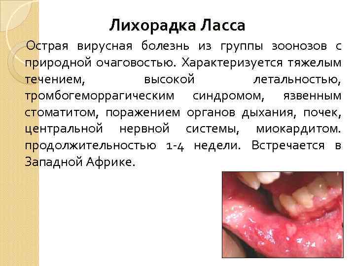 Лихорадка Ласса Острая вирусная болезнь из группы зоонозов с природной очаговостью. Характеризуется тяжелым течением,