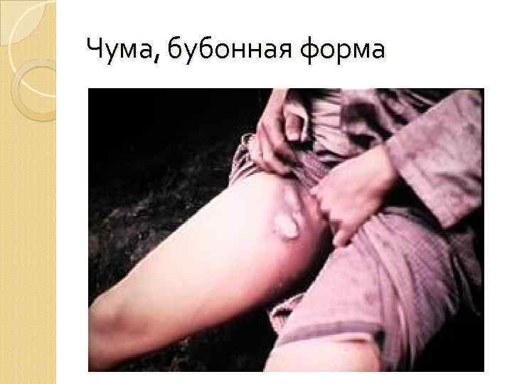 Чума, бубонная форма 