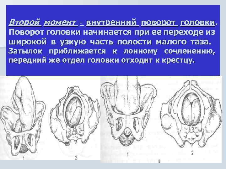 Второй момент - внутренний поворот головки. Поворот головки начинается при ее переходе из широкой