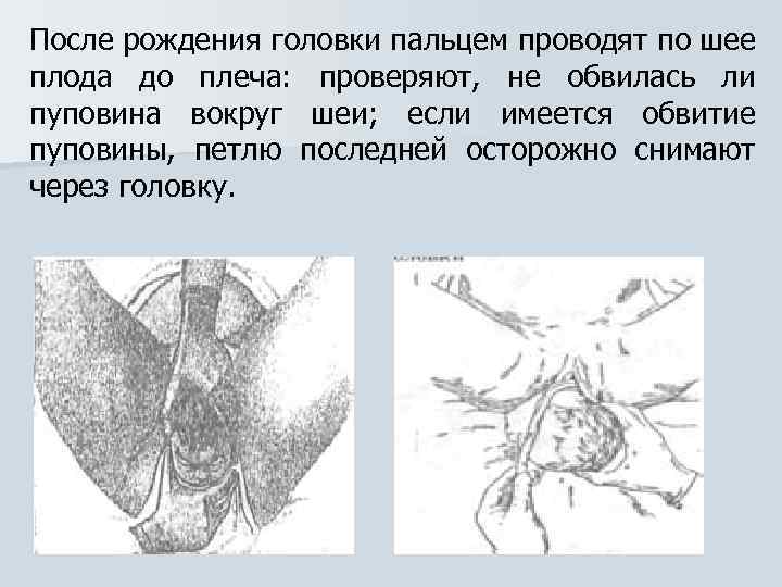 После рождения головки пальцем проводят по шее плода до плеча: проверяют, не обвилась ли