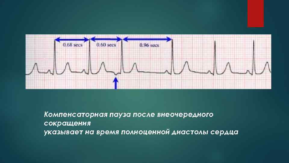Компенсаторная пауза после внеочередного сокращения указывает на время полноценной диастолы сердца 