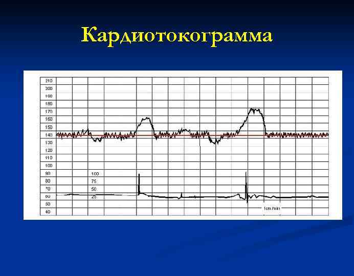 Кардиотокограмма 