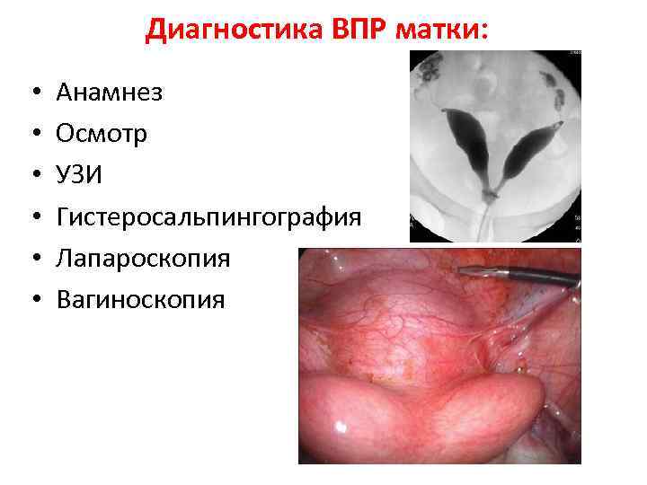 Диагностика ВПР матки: • • • Анамнез Осмотр УЗИ Гистеросальпингография Лапароскопия Вагиноскопия 
