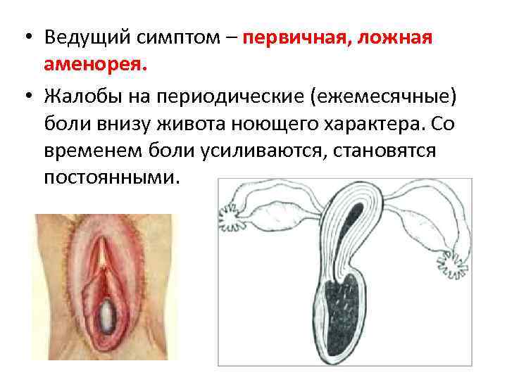  • Ведущий симптом – первичная, ложная аменорея. • Жалобы на периодические (ежемесячные) боли