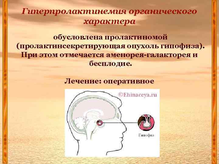 Гиперпролактинемия органического характера обусловлена пролактиномой (пролактинсекретирующая опухоль гипофиза). При этом отмечается аменорея-галакторея и бесплодие.