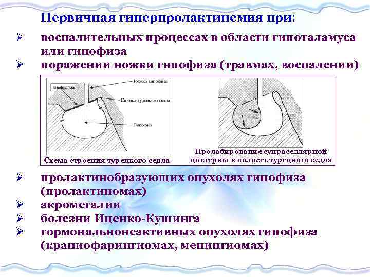 Первичная гиперпролактинемия при Ø Ø воспалительных процессах в области гипоталамуса или гипофиза поражении ножки