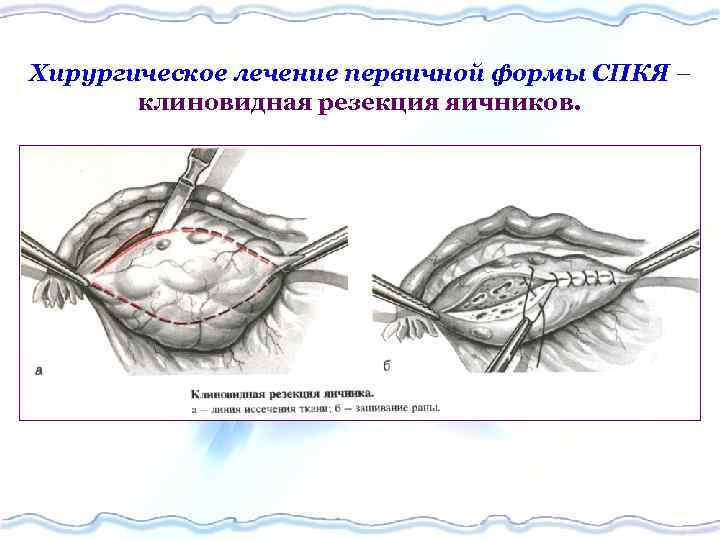 Хирургическое лечение первичной формы СПКЯ – клиновидная резекция яичников. 