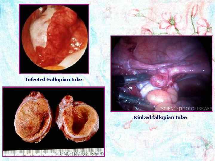 Infected Fallopian tube Kinked fallopian tube 