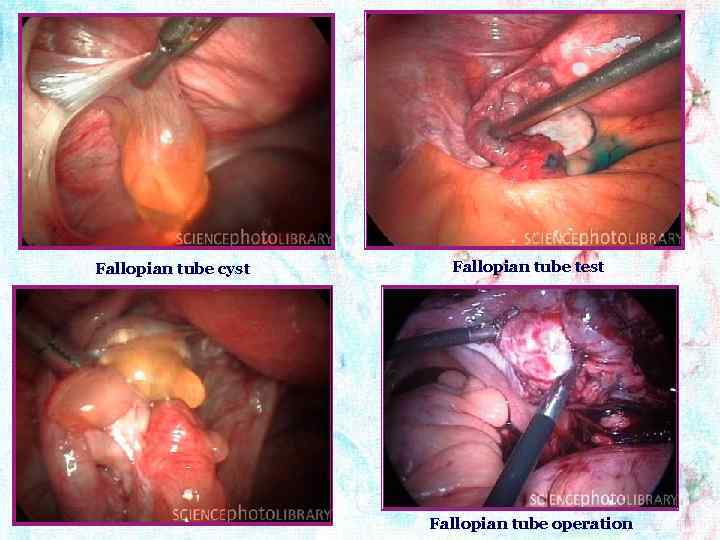 Fallopian tube cyst Fallopian tube test Fallopian tube operation 