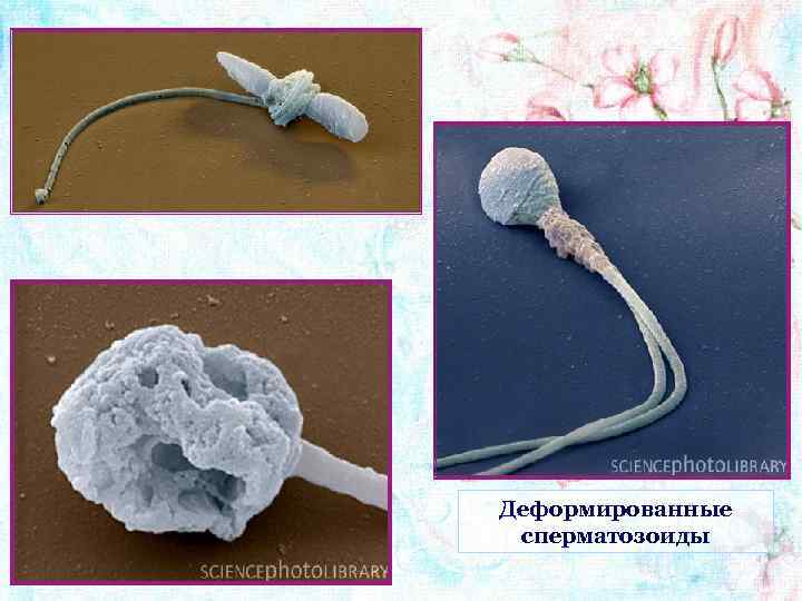 Деформированные сперматозоиды 