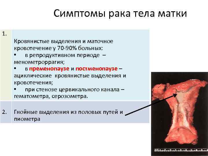 Симптомы рака тела матки 1. 2. Кровянистые выделения и маточное кровотечение у 70 -90%