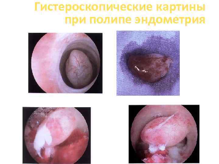 Гистероскопические картины при полипе эндометрия 