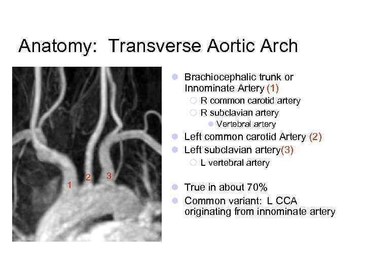 Anatomy: Transverse Aortic Arch l Brachiocephalic trunk or Innominate Artery (1) ¡ R common