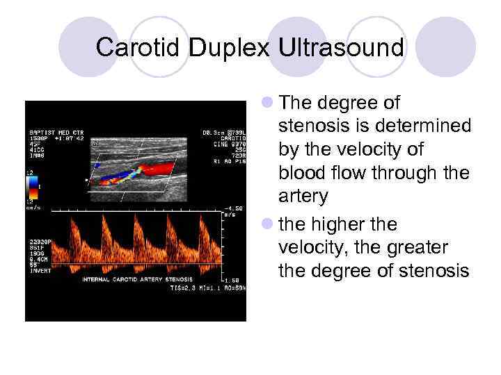 Carotid Duplex Ultrasound l The degree of stenosis is determined by the velocity of