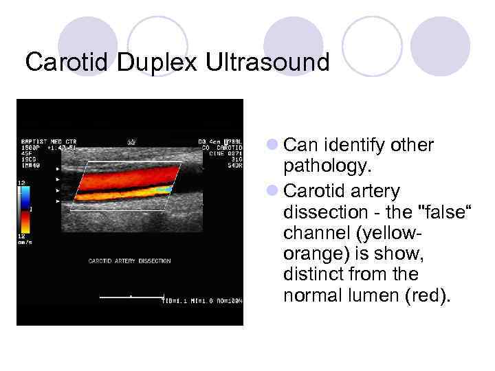 Carotid Duplex Ultrasound l Can identify other pathology. l Carotid artery dissection - the