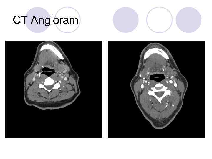 CT Angioram 