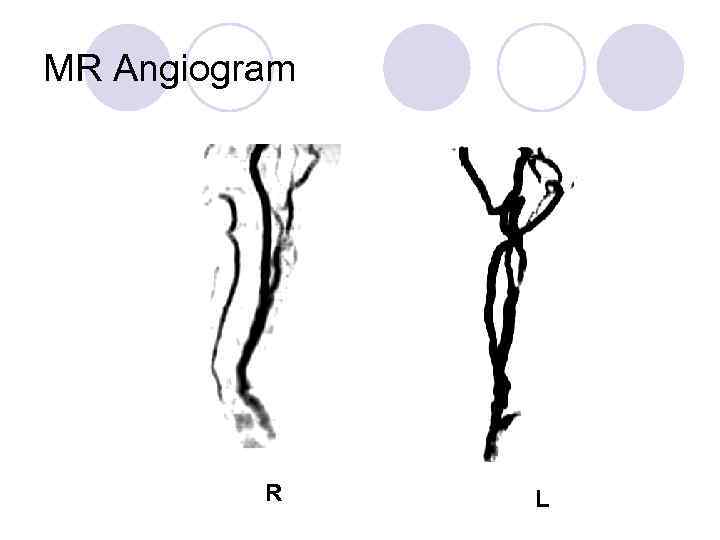 MR Angiogram R L 