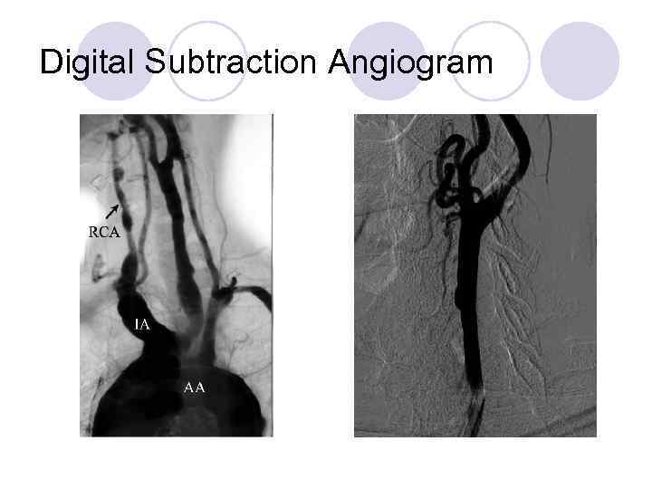 Digital Subtraction Angiogram 