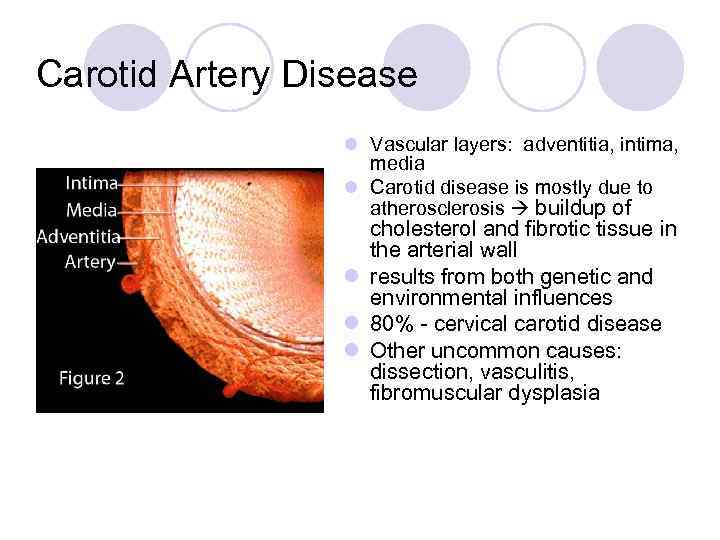 Carotid Artery Disease l Vascular layers: adventitia, intima, media l Carotid disease is mostly