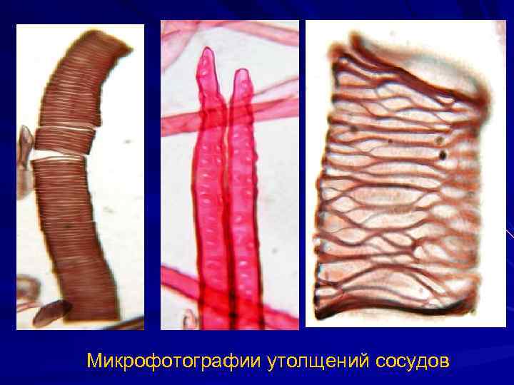 Микрофотографии утолщений сосудов 